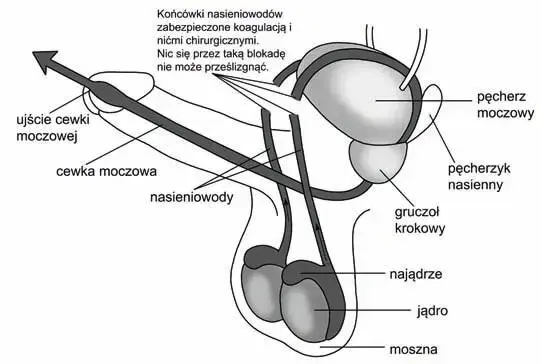 Czy wazektomia to grzech? Odkryj moralne dylematy w Kościele katolickim